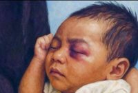 Seorang Bayi yang menjadi korban kekerasan sebagai representasi tingginya kasus kekerasan terhadap Anak yang masih terjadi dan menjadi perhatian serius Pemerintah.