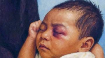 Seorang Bayi yang menjadi korban kekerasan sebagai representasi tingginya kasus kekerasan terhadap Anak yang masih terjadi dan menjadi perhatian serius Pemerintah.